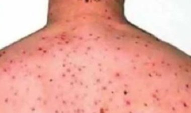 दो मरीजों में पाए गए मंकिपॉक्स के लक्षण, स्वास्थ्य विभाग एलर्ट मोड पर जांच के लिए भेजे गये नमूने