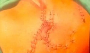 पिटबुल नस्ल के कुत्ते ने बच्चे  पर किया जान लेवा हमला  मुंह पर आए करीब 200 टांके