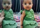 आरबीएसके की पहल से नन्ही आशी के चेहरे पर लौटी मुस्कान, परिवार ने जताया आभार