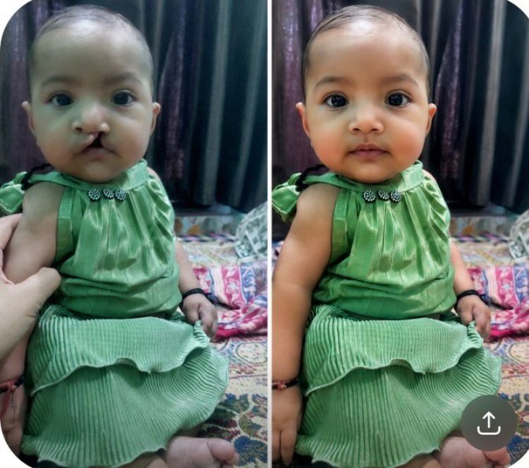 आरबीएसके की पहल से नन्ही आशी के चेहरे पर लौटी मुस्कान, परिवार ने जताया आभार